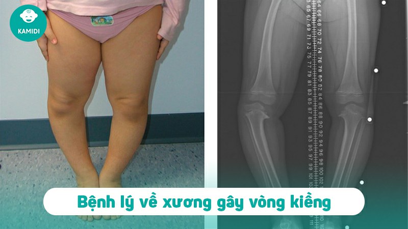 dong-bim-cho-tre-so-sinh-co-bi-vong-kieng-khong-4