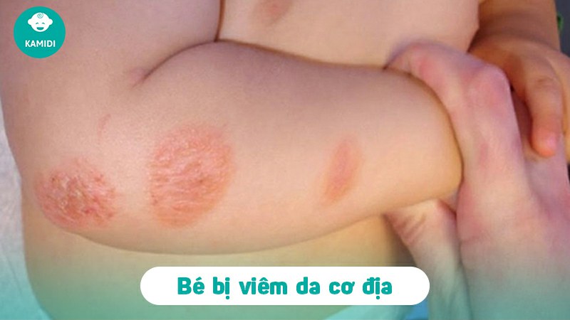 Viêm da cơ địa trẻ em: Nguyên nhân và cách điều trị 2 viem-da-co-dia-tre-em-1
