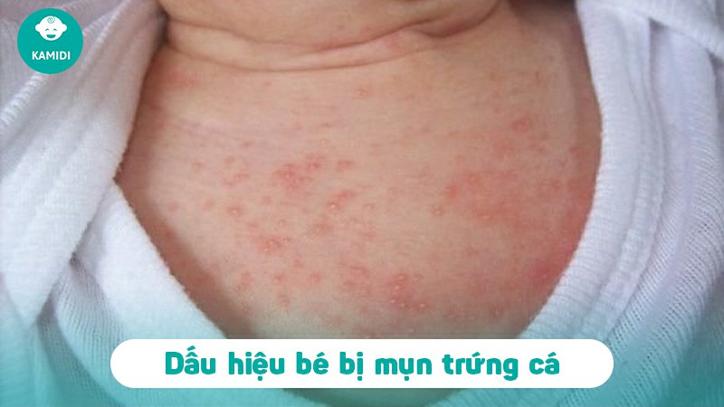 Mụn trứng cá ở trẻ sơ sinh có nguy hiểm không? Nguyên nhân và cách điều trị 2 mun-trung-ca-o-tre-so-sinh-1
