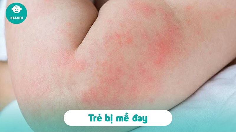 Mụn trứng cá ở trẻ sơ sinh có nguy hiểm không? Nguyên nhân và cách điều trị 3 mun-trung-ca-o-tre-so-sinh-2