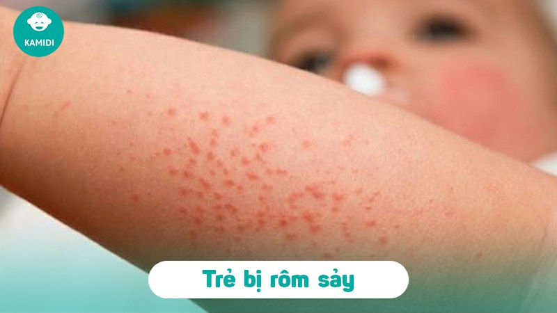 Mụn trứng cá ở trẻ sơ sinh có nguy hiểm không? Nguyên nhân và cách điều trị 4 mun-trung-ca-o-tre-so-sinh-3
