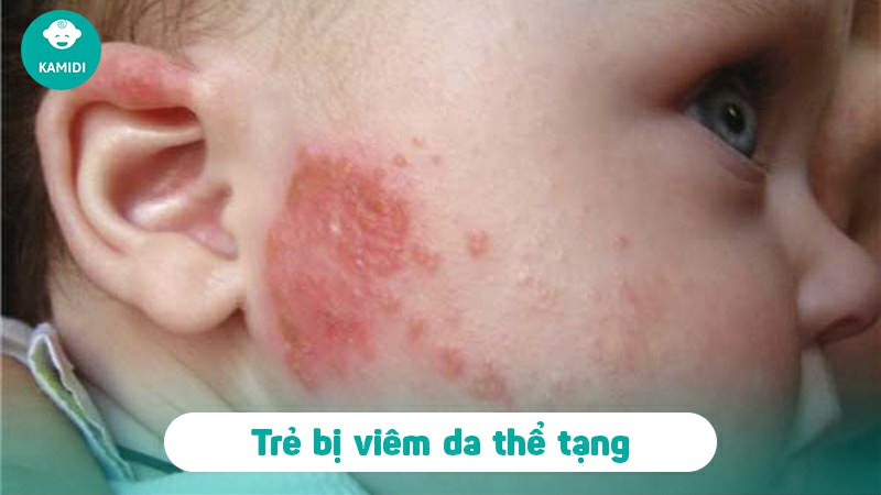 Mụn trứng cá ở trẻ sơ sinh có nguy hiểm không? Nguyên nhân và cách điều trị 5 mun-trung-ca-o-tre-so-sinh-4