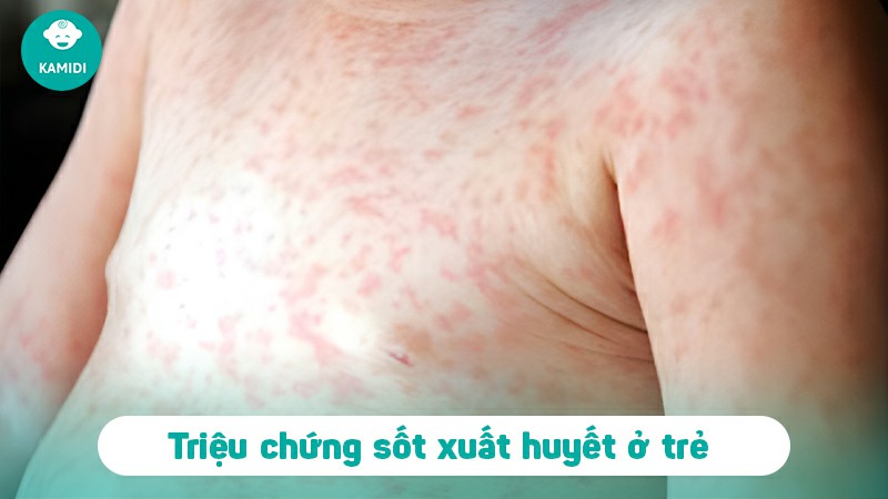 Triệu chứng sốt xuất huyết ở trẻ em là gì? Ba mẹ nên xử lý thế nào khi bé bị sốt xuất huyết 3 trieu-chung-sot-xuat-huyet-o-tre-em-2