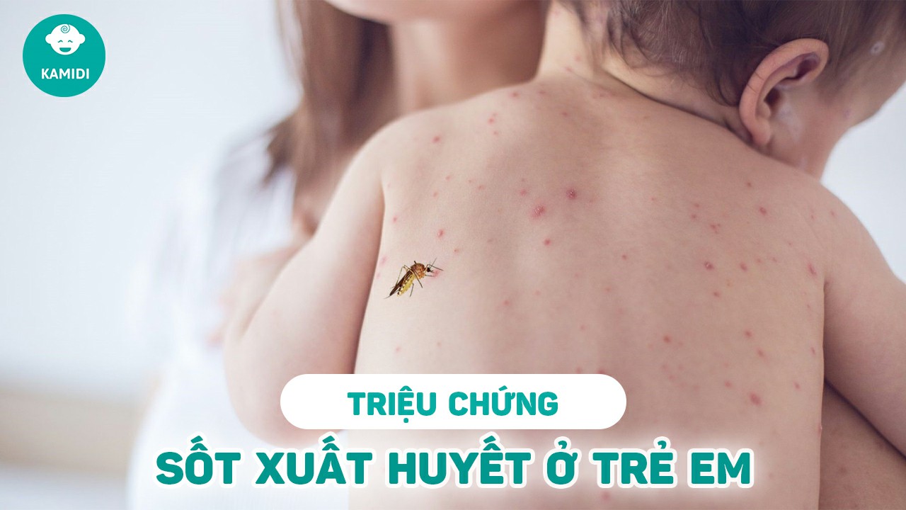 trieu-chung-sot-xuat-huyet-o-tre-em
