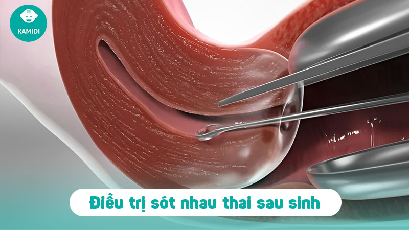 Sót nhau thai sau sinh: Nguyên nhân, triệu chứng và cách điều trị 3 sot-nhau-thai-sau-sinh-2