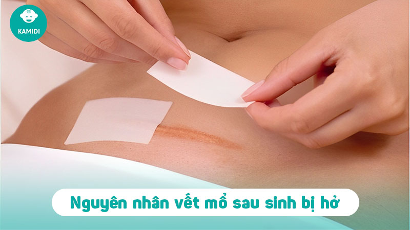 Vết mổ sau sinh bị hở: Nguyên nhân và cách điều trị 2 vet-mo-sau-sinh-bi-ho-1