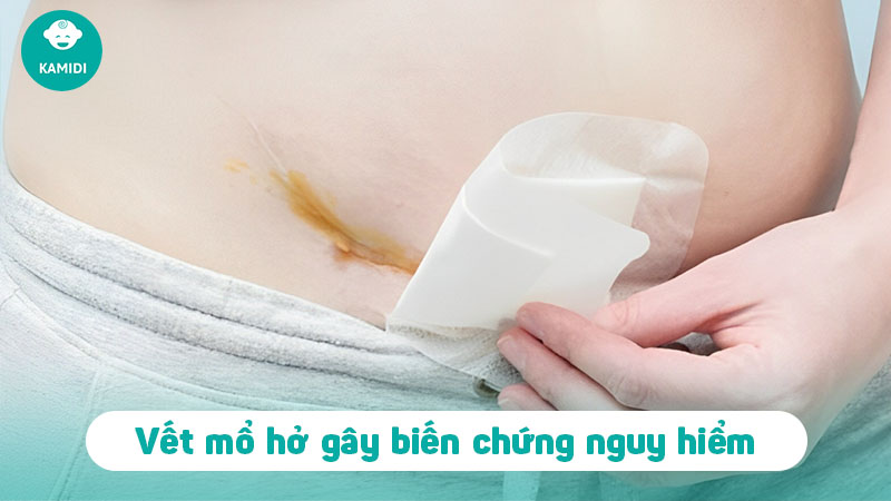 Vết mổ sau sinh bị hở: Nguyên nhân và cách điều trị 3 vet-mo-sau-sinh-bi-ho-2