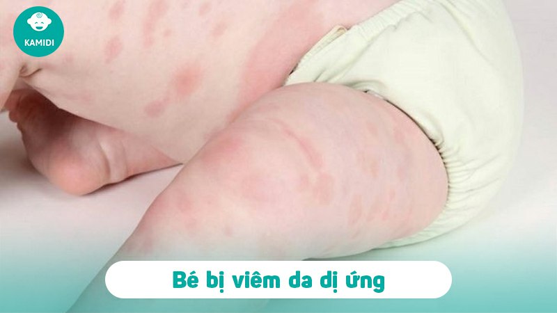 nhiem-trung-da-o-tre-so-sinh-1