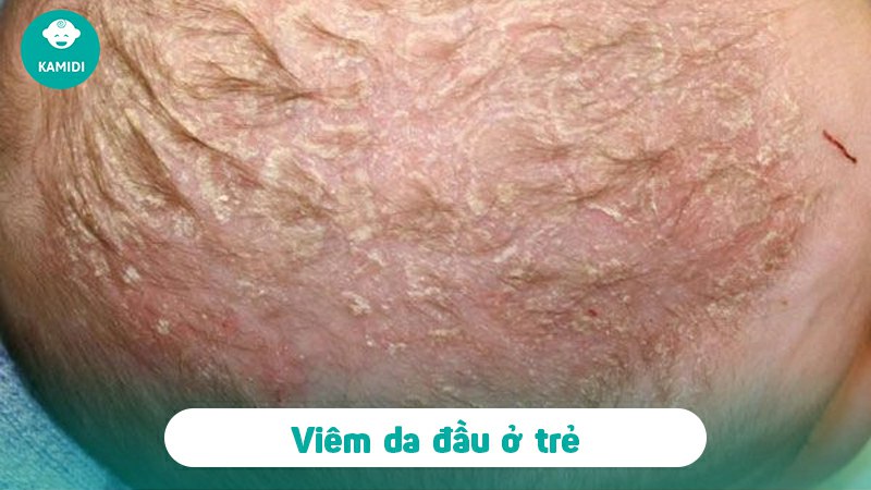 nhiem-trung-da-o-tre-so-sinh-2