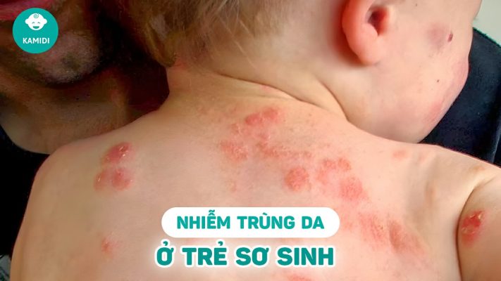 nhiem-trung-da-o-tre-so-sinh